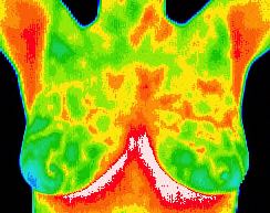 Normal thermal pattern