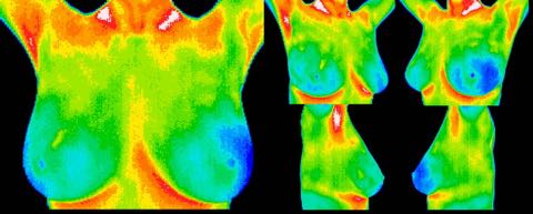 Early DCIS (ductal carcinoma in situ), age 30

