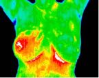 11- Inflammatory cancer, asymptomatic and unsuspected.jpg