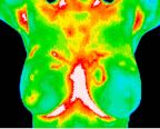 12- Cancer, DCIS (1 of 3 of this study) medial left breast.jp2