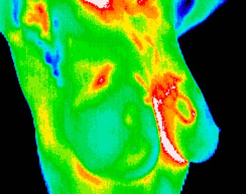 DCIS (2 of 3 of this study) medial left breast