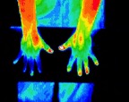 3- Neuropathy in fingers of right hand.jp2