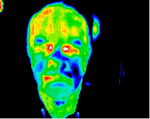 Bell's palsy