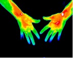 6- Early carpal tunnel in both hands.jp2