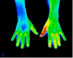 7- Chronic right carpal tunnel syndrome.jp2