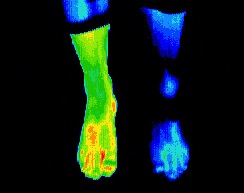 Left ankle fracture